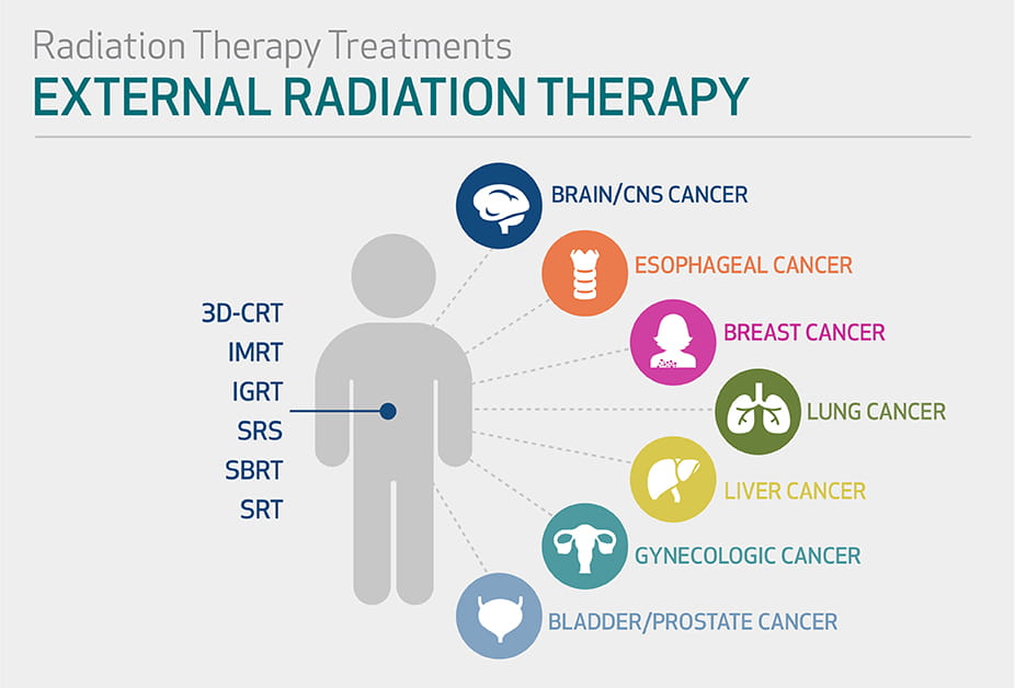 Radiation Therapy | Houston Methodist