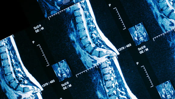 Could A Herniated Disc Be The Cause of Your Back Pain? - Peak Ortho