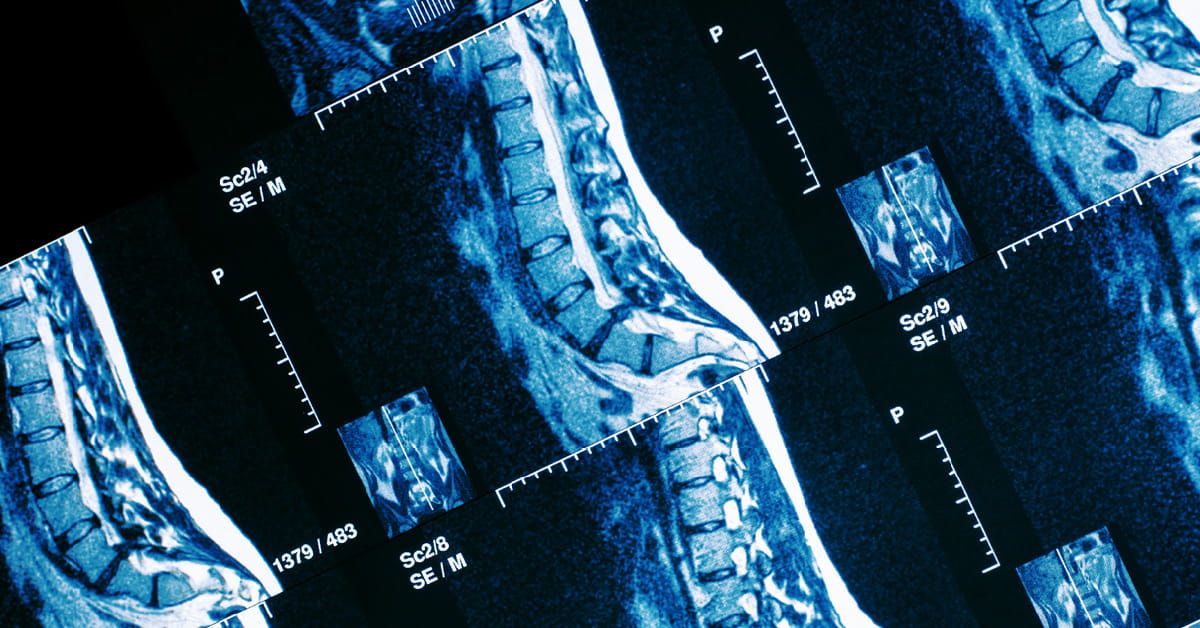 Could A Herniated Disc Be Causing Your Neck Or Back Pain? 