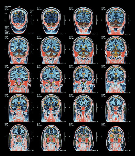 multiple views of brain MRI