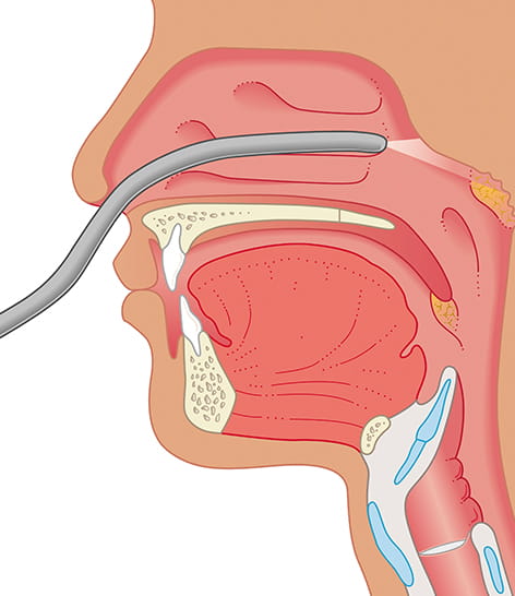 nasal edoscopy