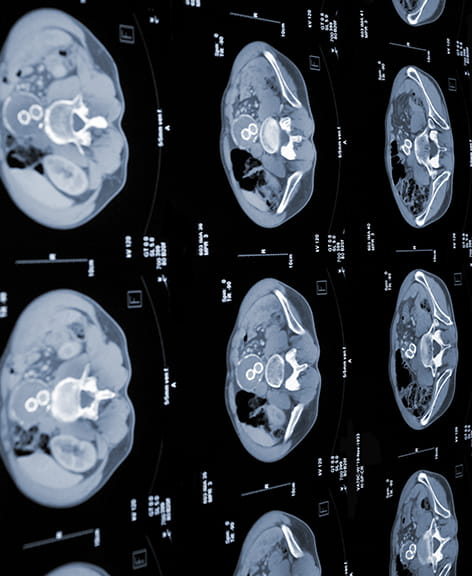 CT scan of abdomen and pelvis