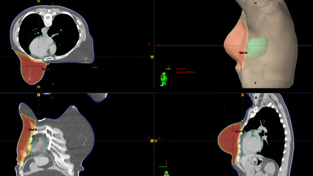 What Breast Cancer Patients Can Expect from Radiation Therapy