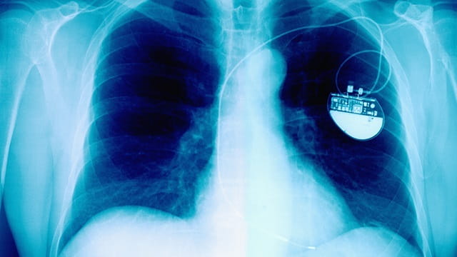 Could Cardioneuroablation Replace Pacemakers As Treatment Of Choice For 