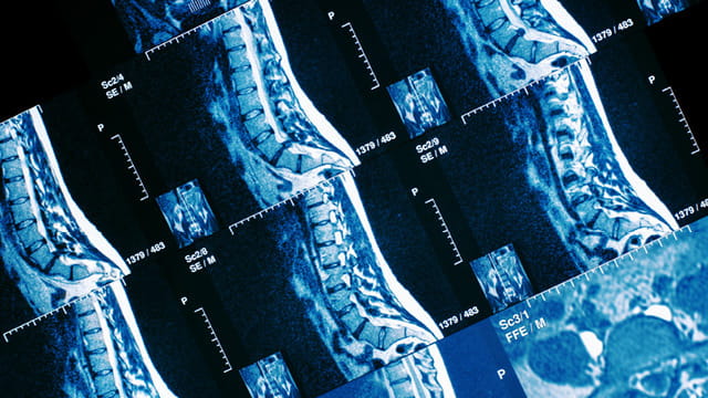 Endoscopic Spine Surgery: A Better Option for Disk Disease Treatment ...