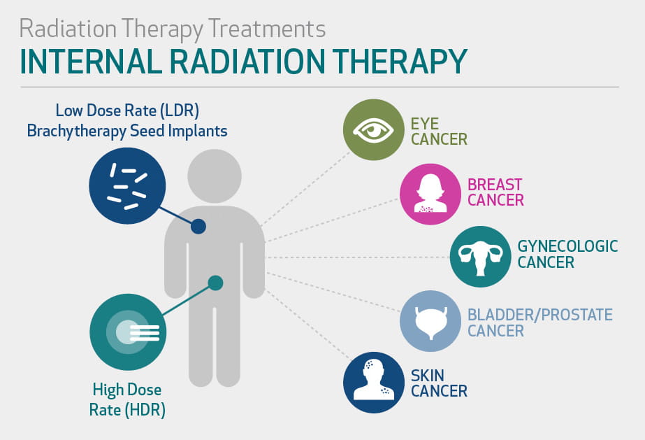 Radiation Therapy: Internal & External Radiation | Houston Methodist