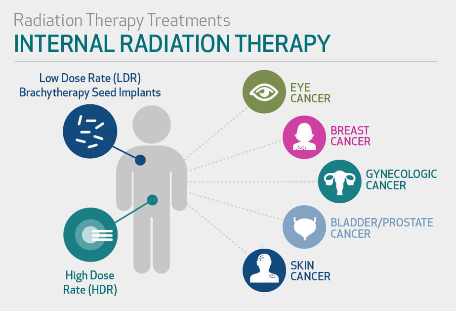 How to Cope with the Side Effects of Radiation Therapy, Radiation Therapy  Treatment
