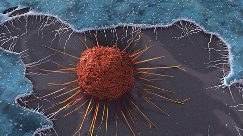 Cervical cancer cell_SEM