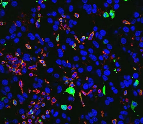 Immune cells positive for a protein, S100A4 (in green) could be a potential therapeutic target for restoring antitumor action of immune cells toward glioblastomas. 